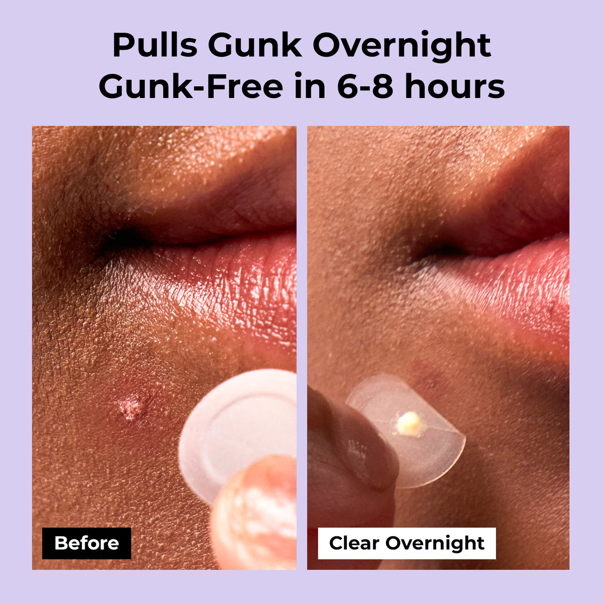 [PGB]A-Clear Spot Patch(Day/Night)-58counts